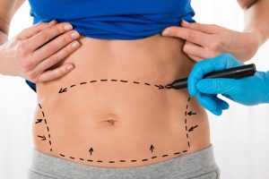 Estómago Con Líneas Para Revisión de Abdominoplastia