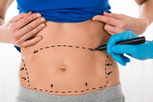 How Can I Correct My Tummy Tuck Results? - Dr. Terry Dubrow